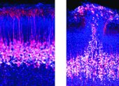 Neuronas piramidales de la capa cinco del córtex en ratones normales (izquierda) comparados con ratones con el gen del autismo eliminado (derecha), mostrando un parche de corteza desorganizada.