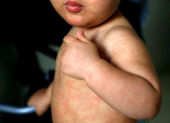 El sarampión produce fiebre alta y machas rojas en el rostro y en el cuerpo.