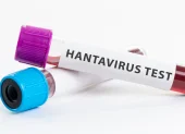 Referencial. Muestras de laboratorio utilizadas en pruebas para detectar hantavirus.