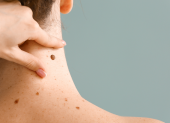 Moderna y Merck anunciaron resultados positivos de una terapia personalizada de ARNm contra el melanoma.