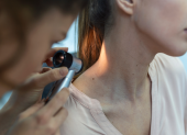 Tener más de 50 lunares en el cuerpo sería una señal de un mayor riesgo de desarrollar cáncer.
