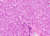 Los fármacos de quimioterapia a base de platino han demostrado ser muy eficaces para combatir el cáncer.