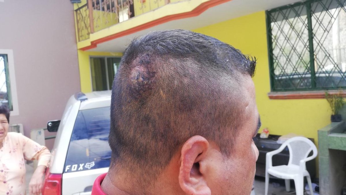 Así quedó la cabeza del hombre que se enfrentó a golpes con Jaime Iván Kaviedes.