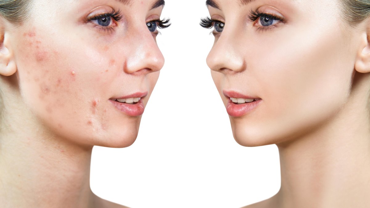 Antes y después de rostro con secuelas de acné.