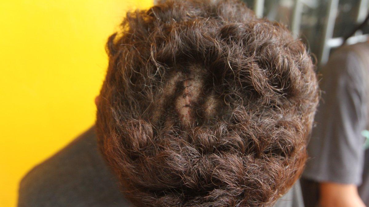 El hincha canario, 'Jordan', muestra a EXPRESO las suturas que tiene en su cabeza tras sobrevivir al accidente mortal en Perú.