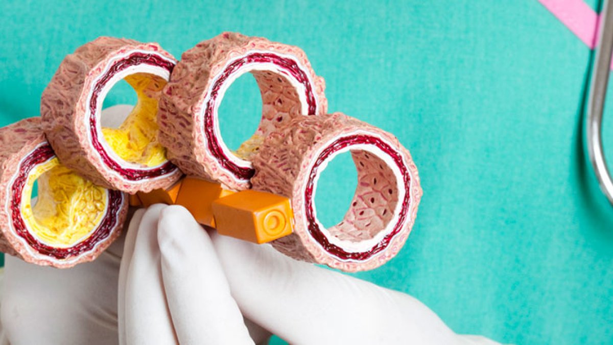 En la gráfica se simula cómo ocurre la acumulación de grasa en las arterias.