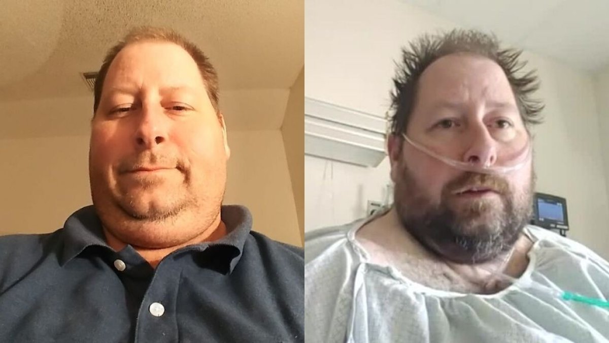 Brian Hitchens, antes y después de la infección.