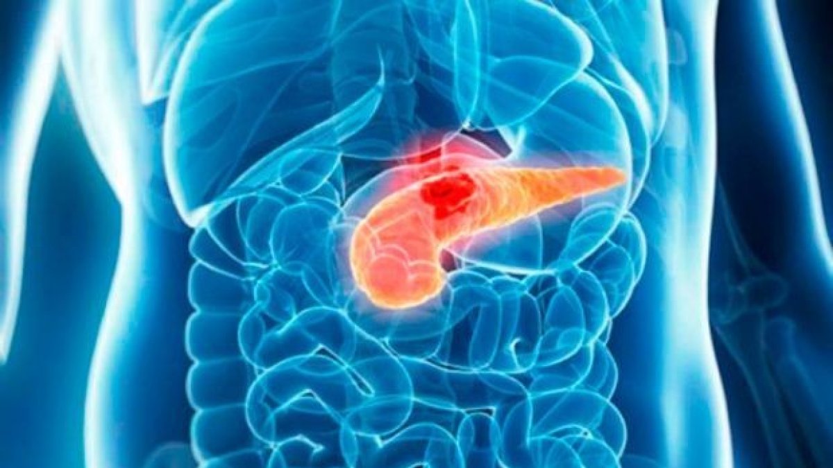 El hallazgo puede cambiar la manera en la que se trata el cancer de páncreas.