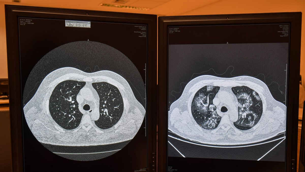 Imágenes de tomografías comparando un pulmón sano (izq) con uno afectado por coronavirus en el mismo paciente.