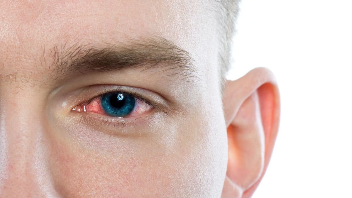 Identifican la conjuntivitis como síntoma principal de la Covid-19.