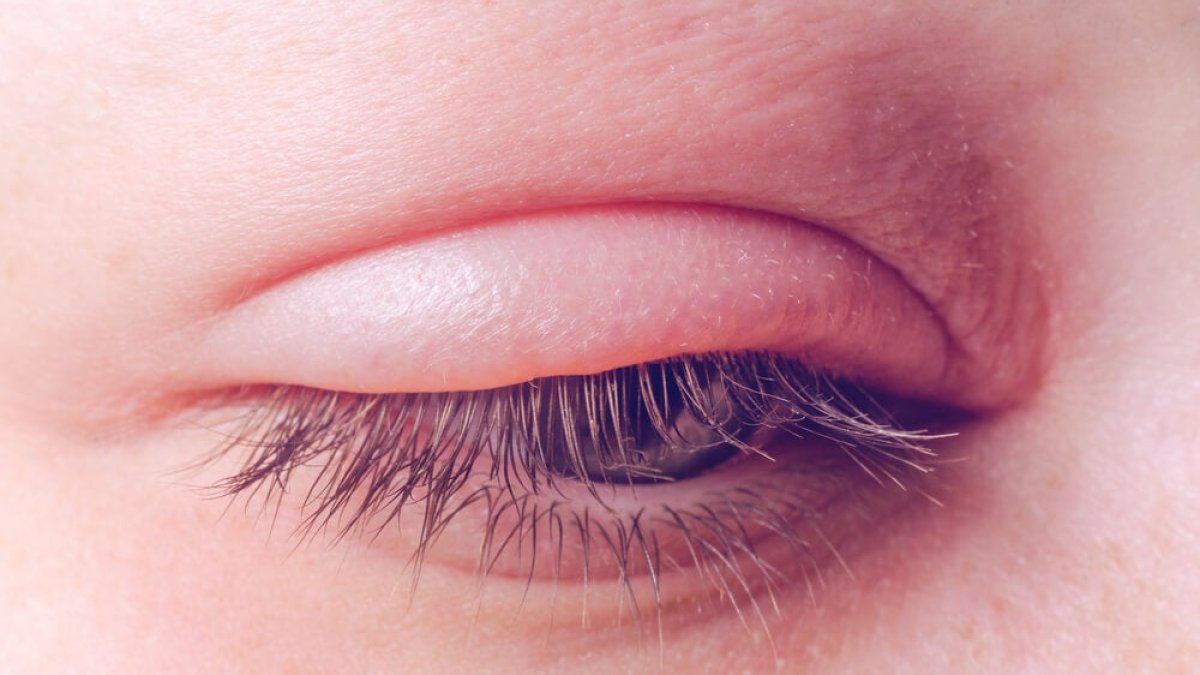 Referencial. Entre los síntomas que pueden presentarse están fiebre, ronchas (eritema) y la inflamación de párpados.