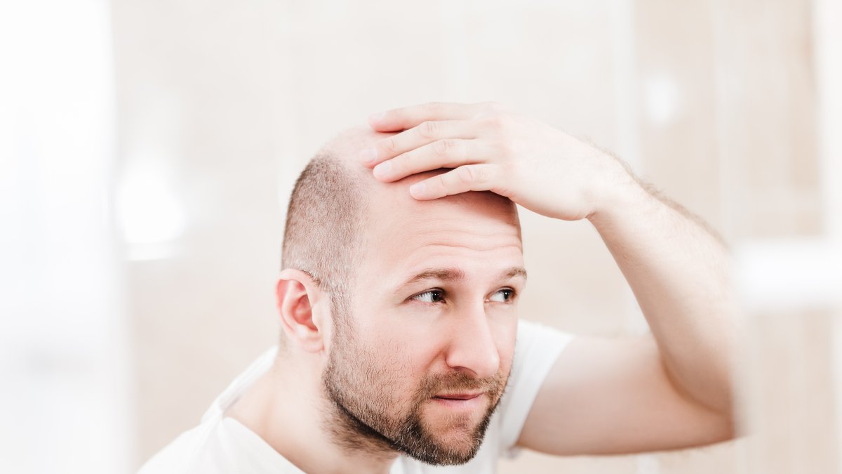 La cirugía de trasplante capilar puede durar hasta doce horas.