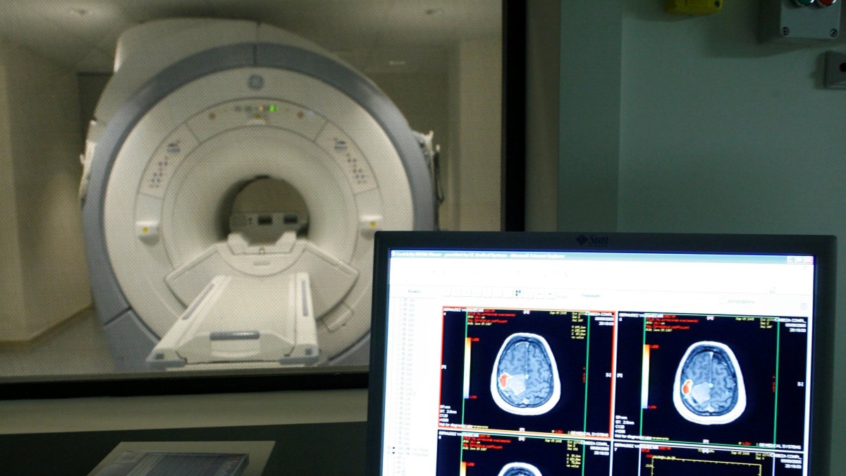 La enfermedad de alzhéimer es un trastorno neurodegenerativo que se caracteriza por el deterioro continuo de la memoria, el comportamiento y las habilidades sociales, lo que finalmente afecta la capacidad de una persona de vivir de manera independiente.