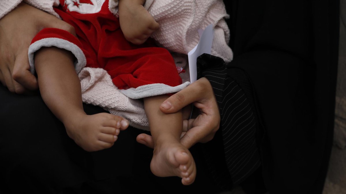 Una mujer sostiene a un niño desnutrido, en Saná, capital de Yemen, el 10 de agosto de 2021