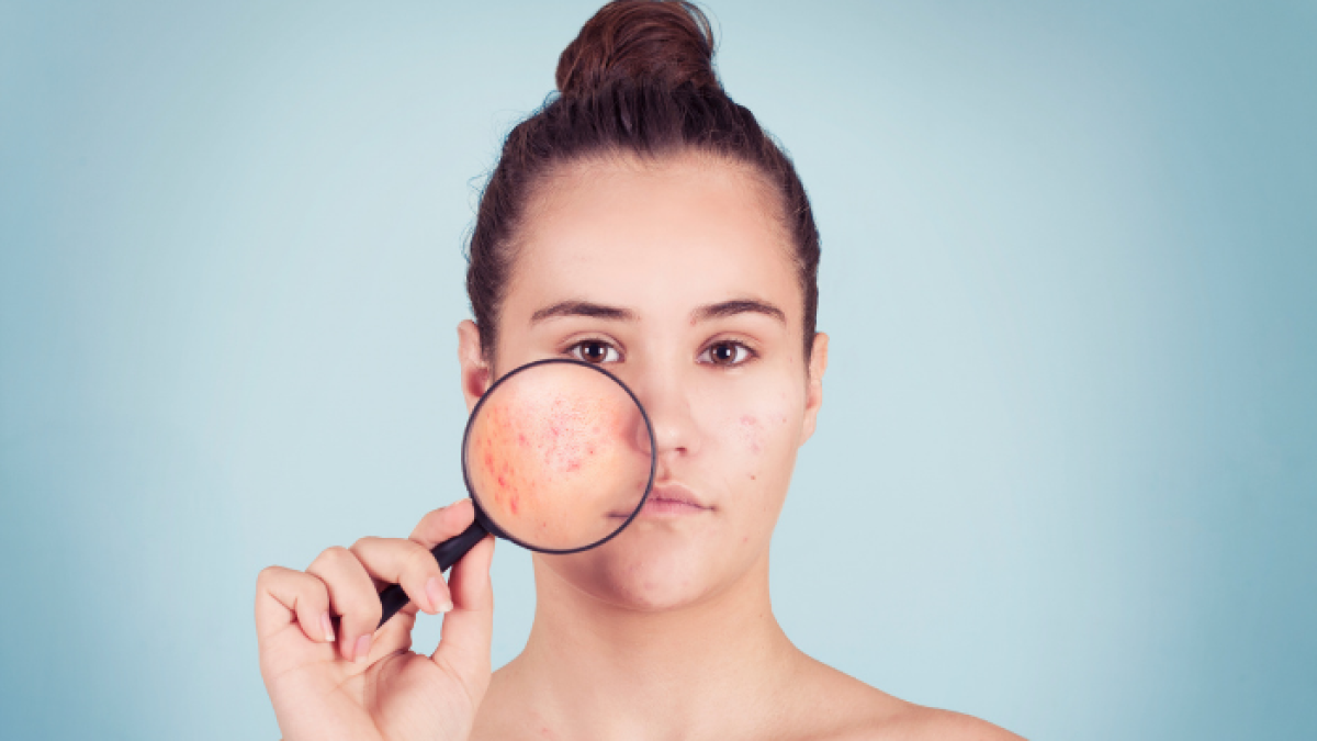 Cuando las glándulas sebáceas producen demasiada grasa, puede aparecer acné.