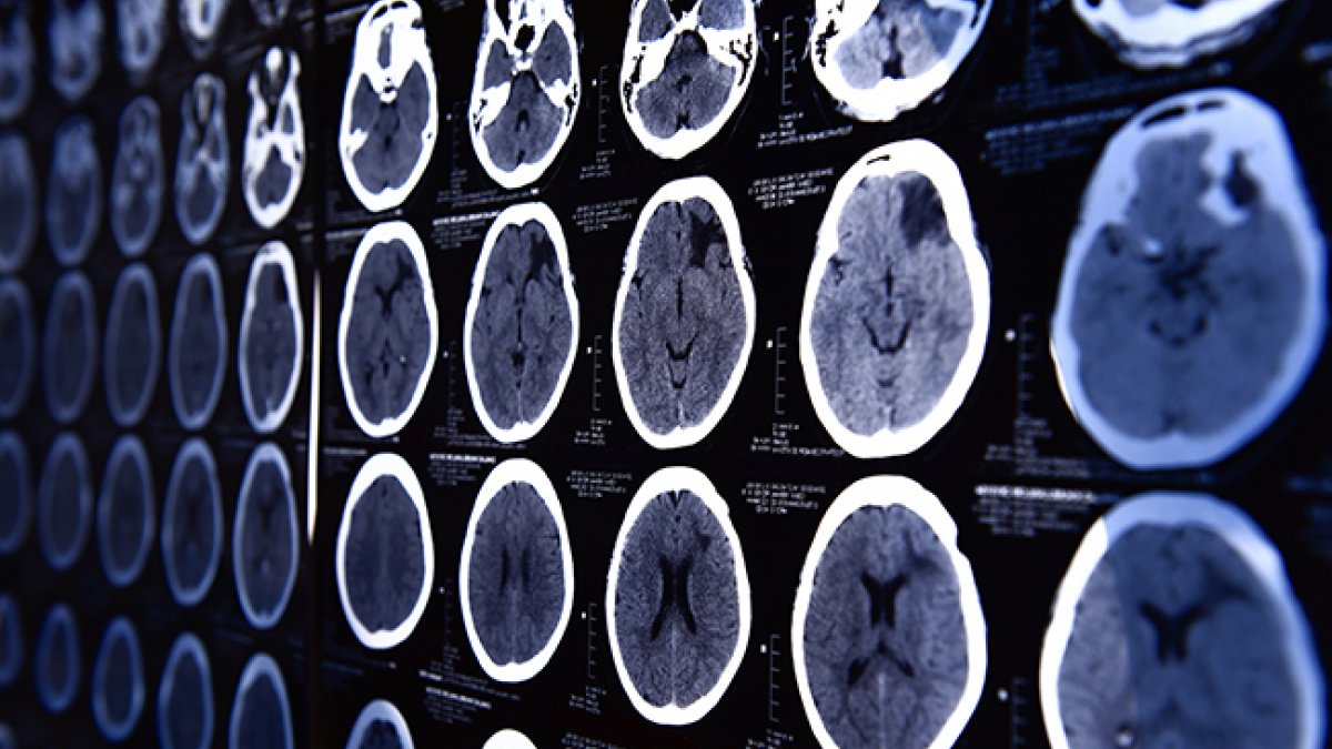 Radiografías del cerebro. un infarto cerebral también puede presentarse en niños y jóvenes