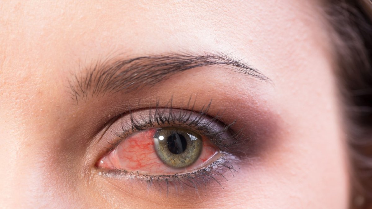 Si el o (los) ojos permanecen rojos por varios días consulte al oftalmólogo.