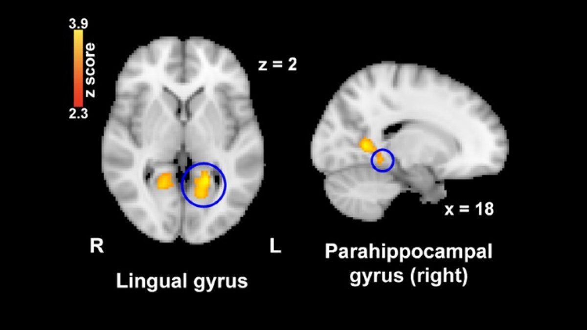 La activación cerebral en el giro lingual y en el giro parahipocampal, áreas involucradas en la percepción del dolor, disminuyó significativamente después de ver imágenes nostálgicas en comparación con las imágenes de control.