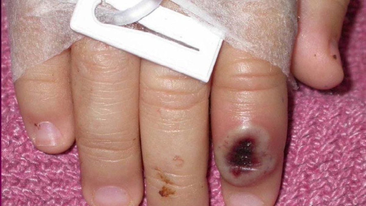 Fotografía de archivo del Centro Estadounidense de Control de las Enfermedades (CDC) en la que se aprecia el dedo de un niño infectado por la llamada 