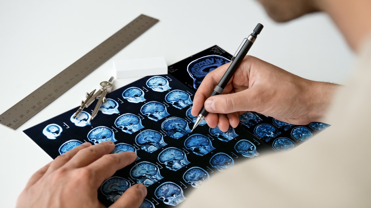 Esta enfermedad  debe ser tratada por el  neurólogo.