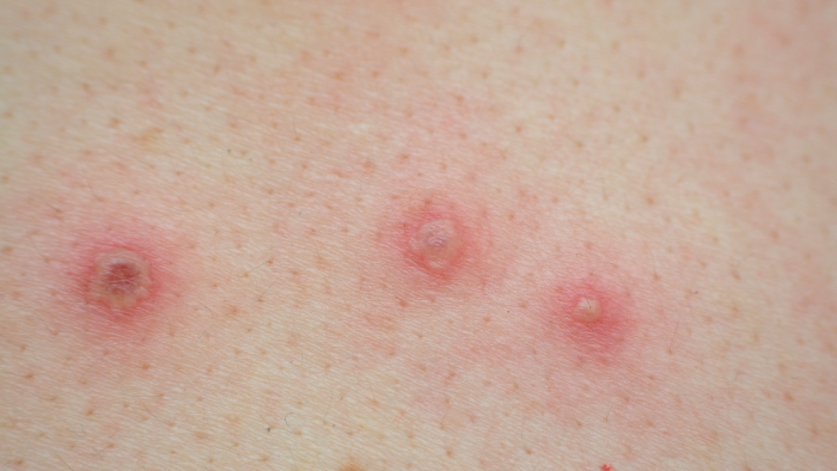 Viruela, referencial.