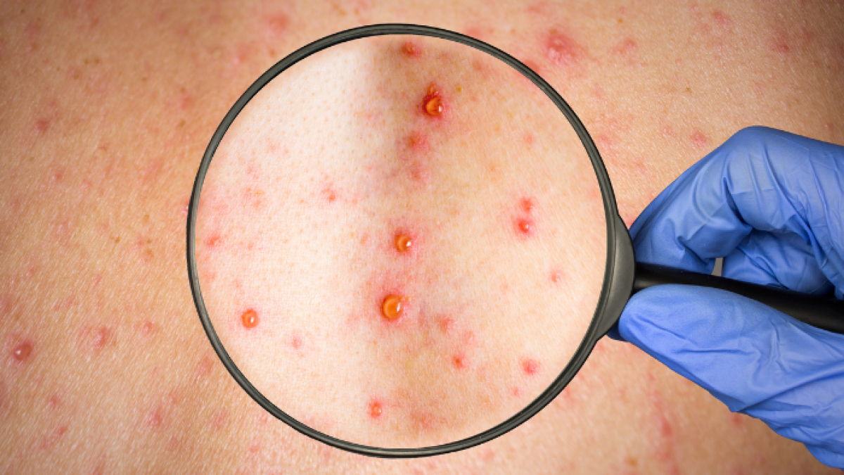 Las erupciones en la piel es uno de los síntomas de la viruela del mono.