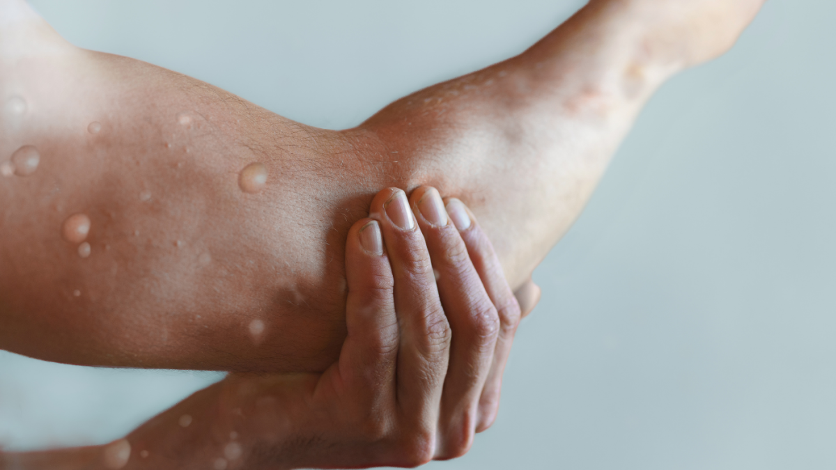 Foto referencial de un infectado de viruela del mono