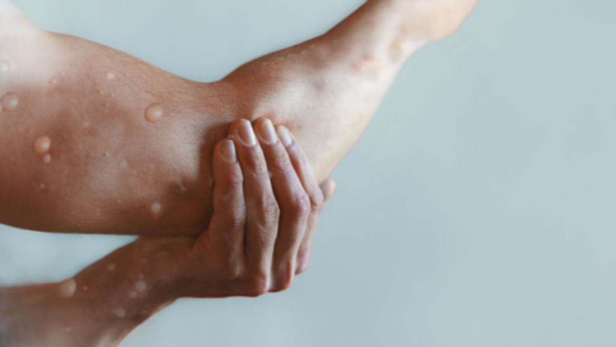 Referencial de viruela del mono.