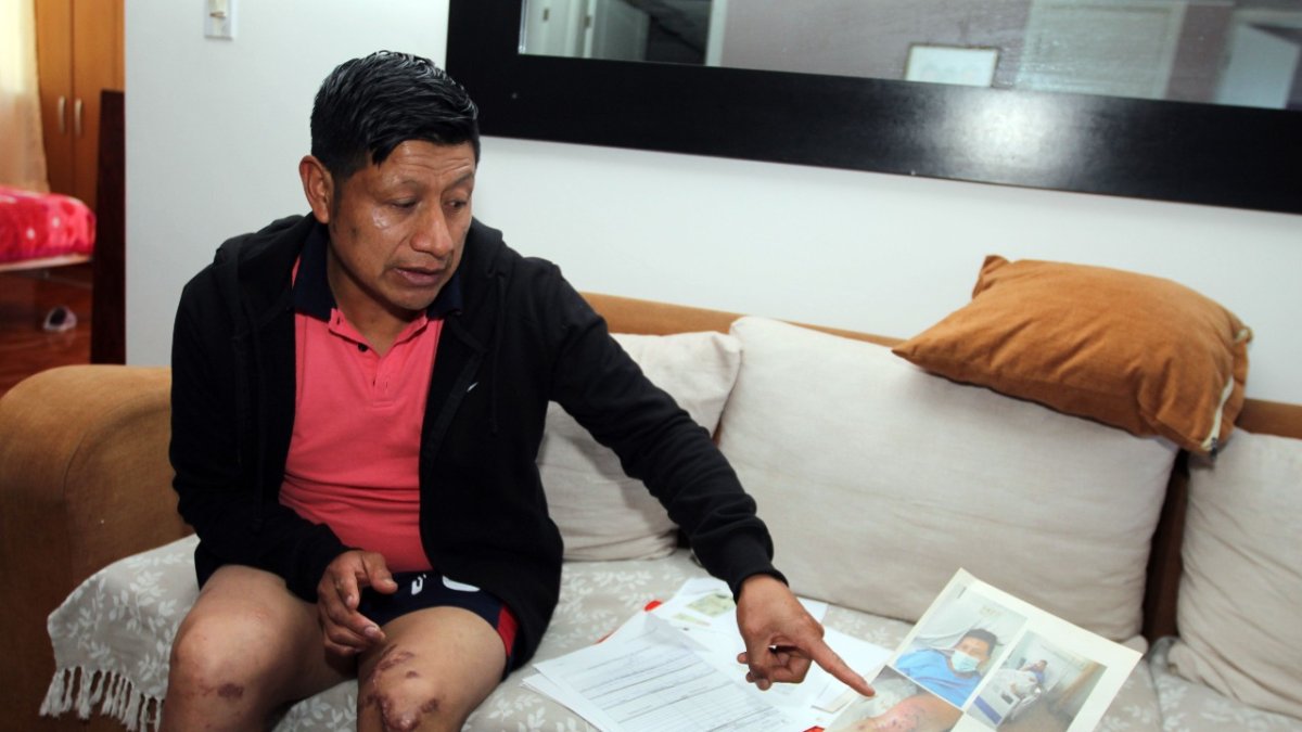 Situación. Así luce la rodilla y corre el riesgo de perder la movilidad en su pierna e incluso ser amputada.