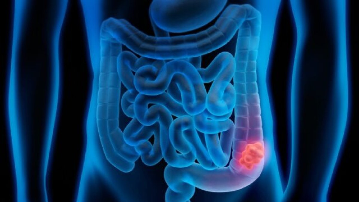 Imagen archivo cáncer de colon
