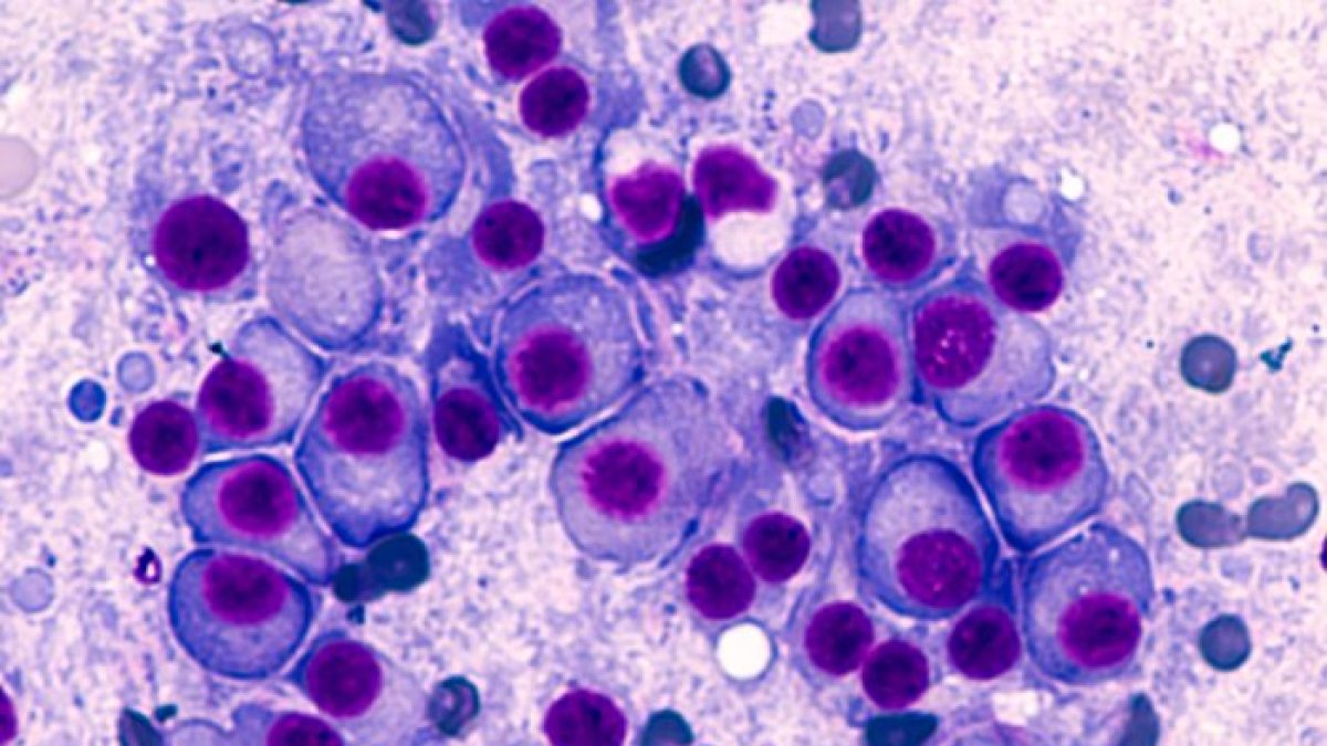 Células mieloma, imagen archivo.