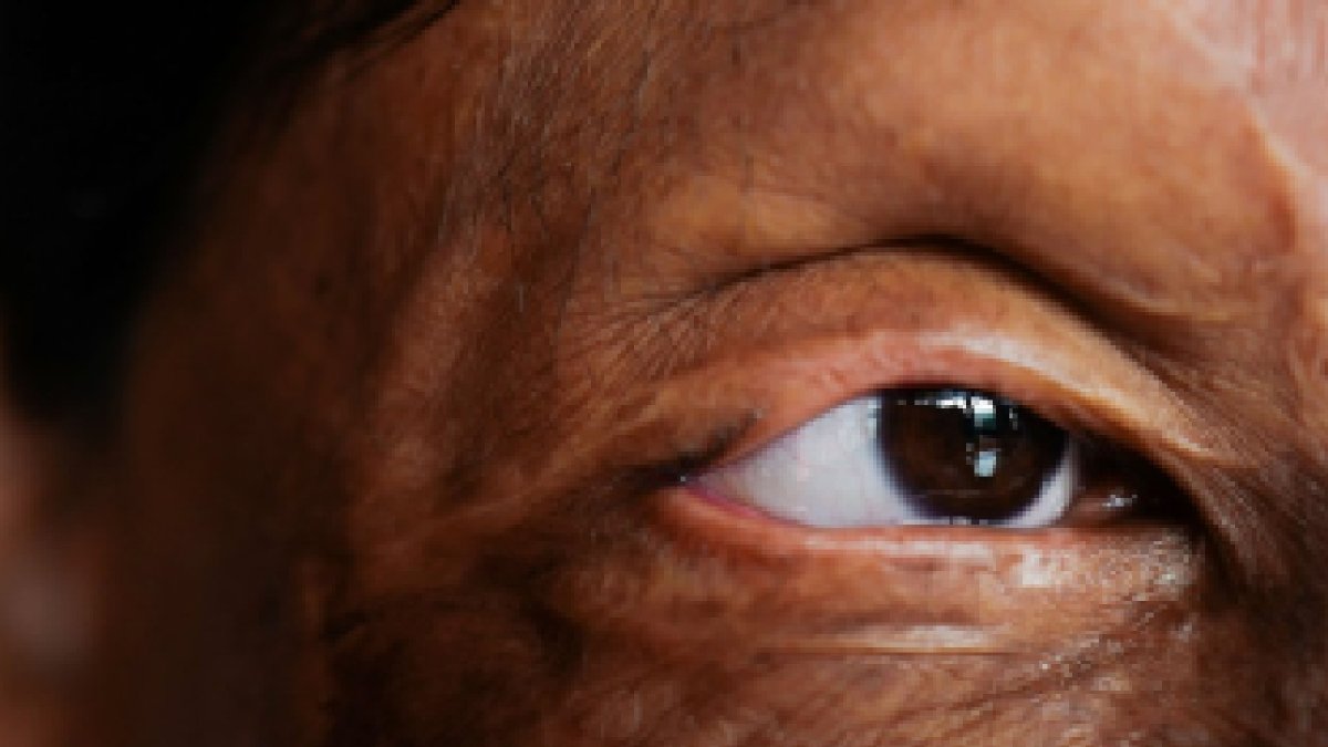 Secuelas de ataque con ácido