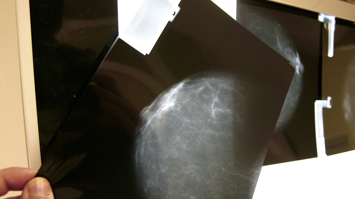 Fotografía de archivo de una prueba radiológica de mama.