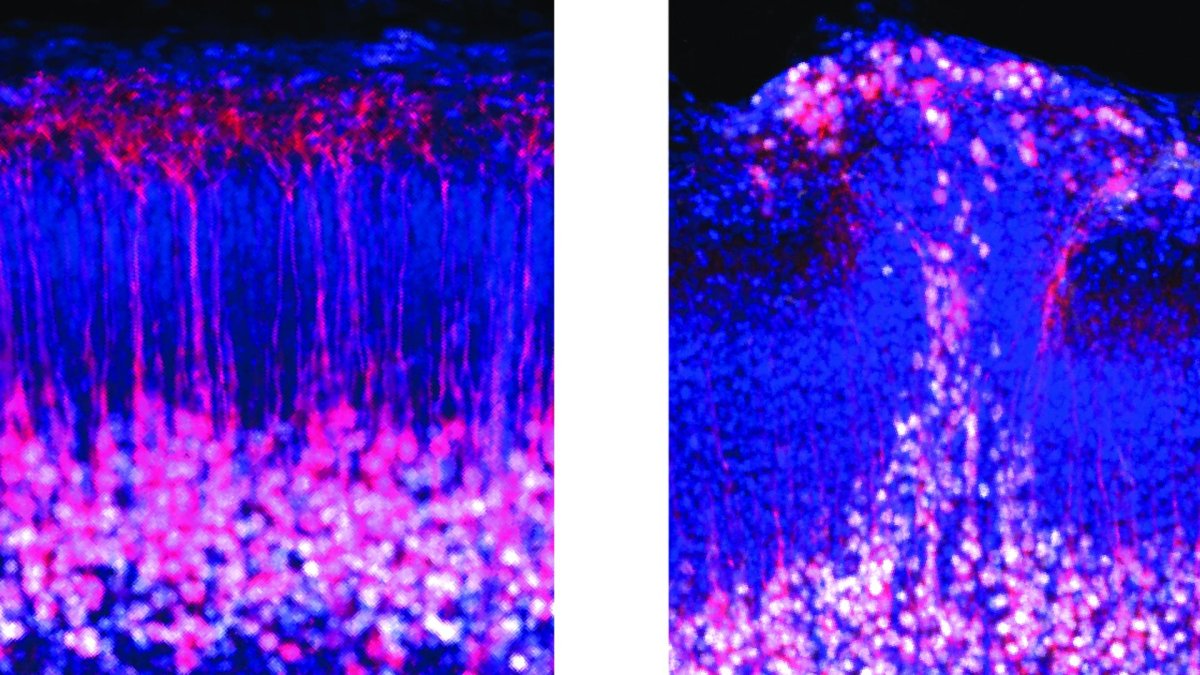 Neuronas piramidales de la capa cinco del córtex en ratones normales (izquierda) comparados con ratones con el gen del autismo eliminado (derecha), mostrando un parche de corteza desorganizada.
