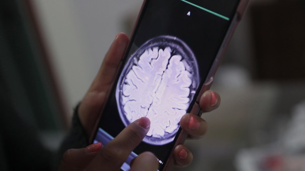 Un equipo de científicos de la Northwestern University ha conseguido que la quimioterapia más potente llegue al cerebro para tratar los gioblastomas.
