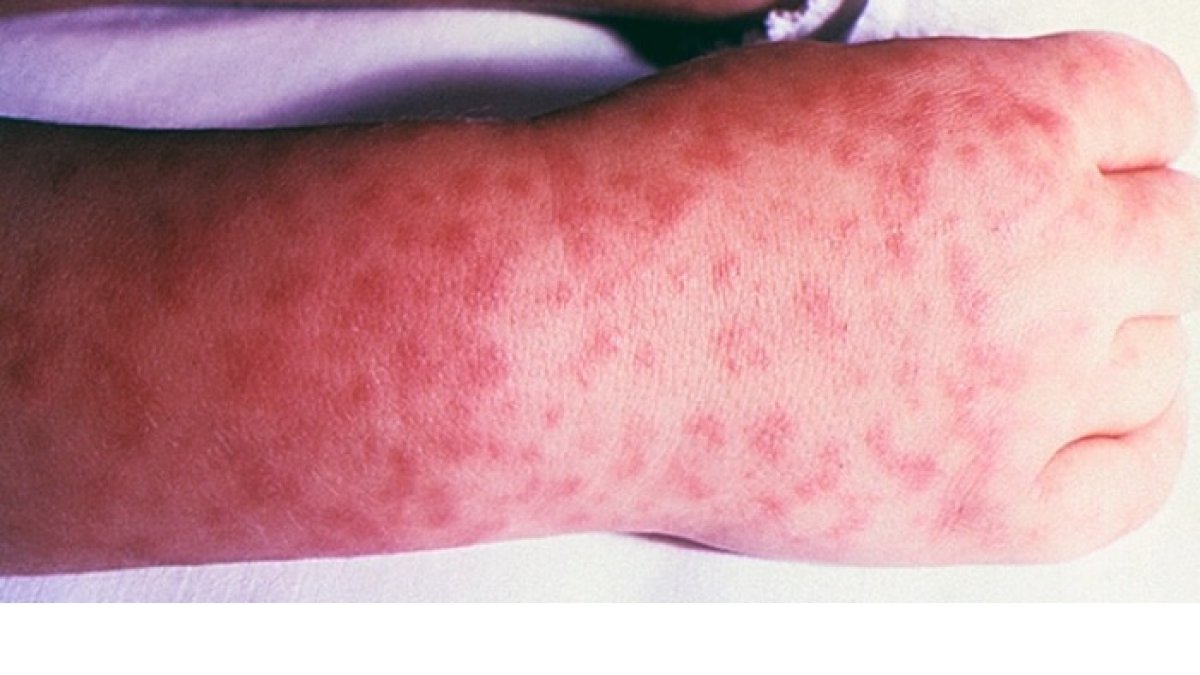 La enfermedad es endémica en América y se encuentra extendida desde América del Sur hasta Estados Unidos.