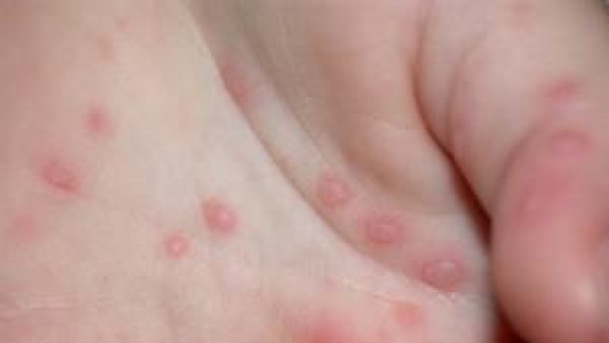 Imagen facilitada por la Asociación Española de Pediatría de un paciente afectado por  el síndrome de manos, pies y boca.