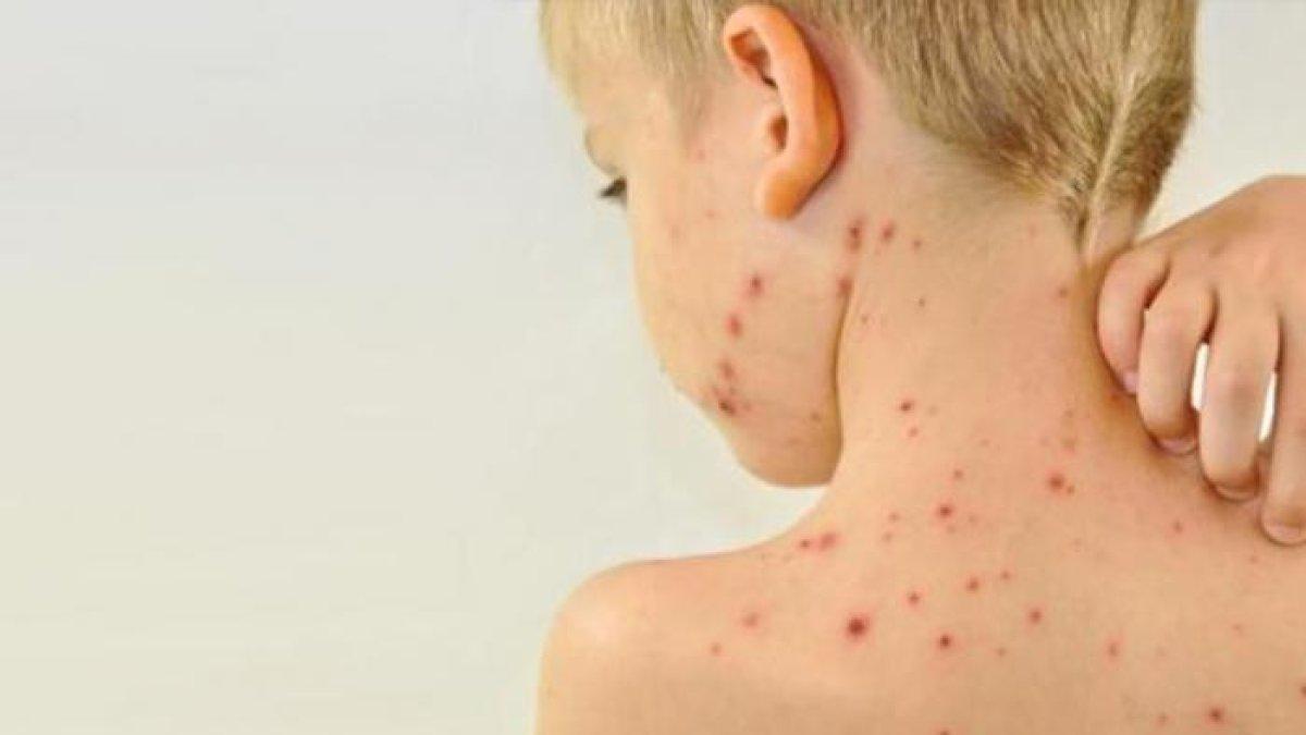 Imagen referencial de niño con sarampión.