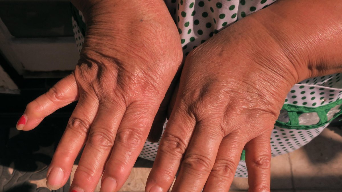 Una mujer muestra su manos con artritis reumatoide en una imagen de archivo.
