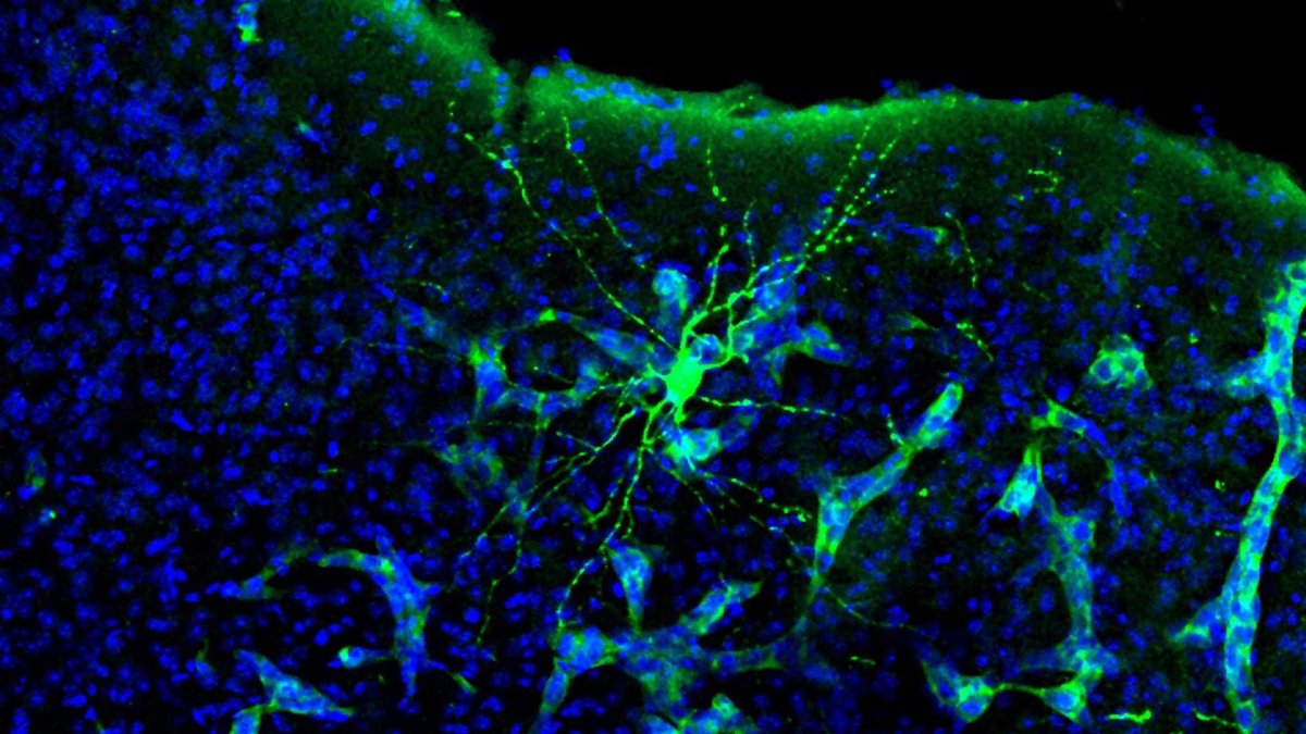 Metástasis en cerebro de ratón. Se aprecia cómo la metástasis (verde más claro) interacciona con una neurona (verde más intenso).