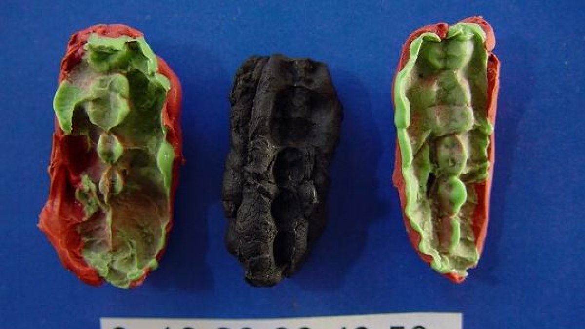 Las caries y las enfermedades de las encías ya acuciaban al hombre hace 10.000 años