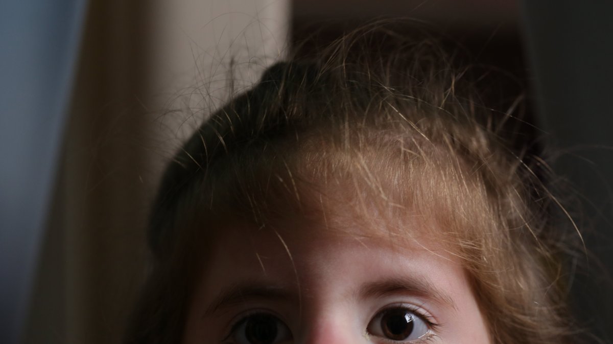 Ana Paula Vera sufre el síndrome de Moebius.