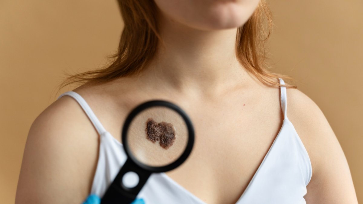 Vigile su lunar. Si cambia de forma, color o tamaño, consulte a su médico