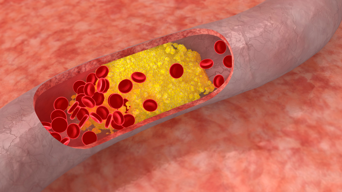 El colesterol es un tipo de lípido o grasa que se encuentra en la sangre.
