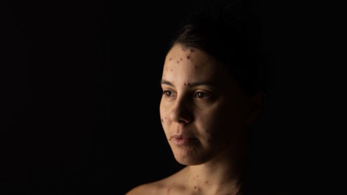 La aparición de erupciones en la piel es la principal característica de la varicela.