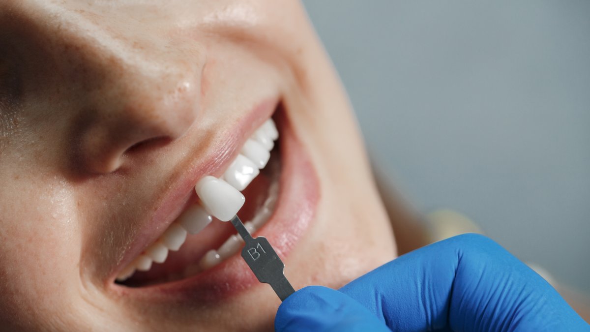 Conoce más sobre las ventajas y desventajas de las carillas dentales o veeners