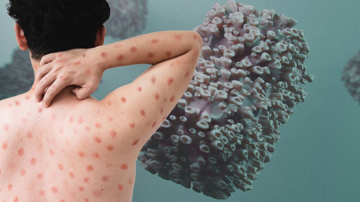 Reconocer los síntomas y buscar atención médica de manera oportuna es crucial para controlar la propagación del virus