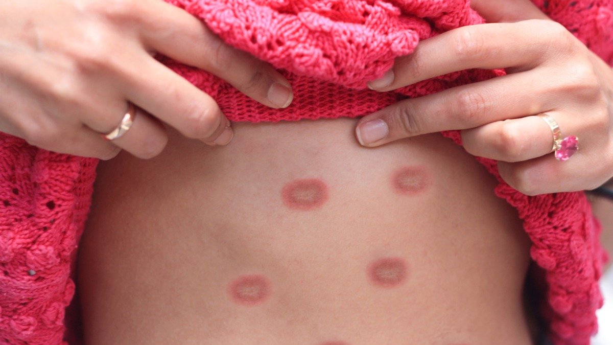 Viruela del mono es declarada emergencia de salud pública global.