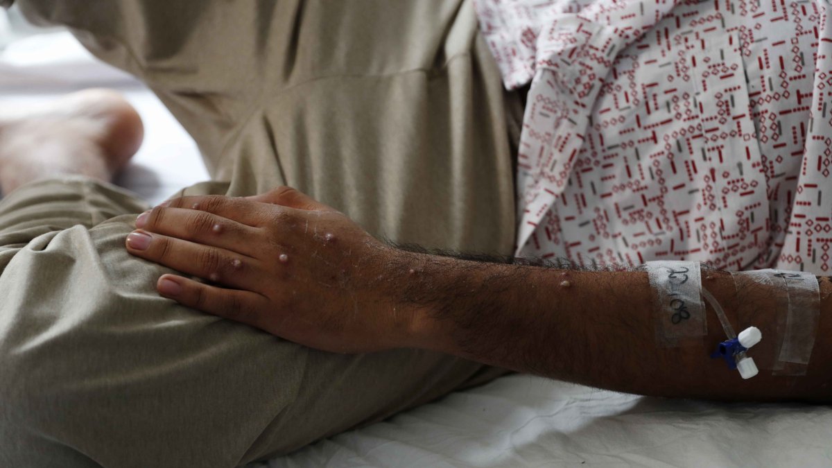 Un paciente es atendido tras ser diagnosticado con mpox.