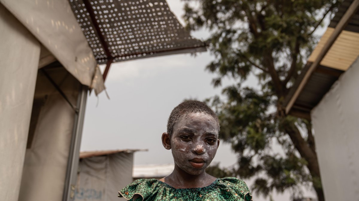 Lucie Habimana, de 13 años, tiene la cara cubierta con ungüento después de recibir tratamiento para el mpox en el Centro de Salud Munigi en Munigi, República Democrática del Congo.